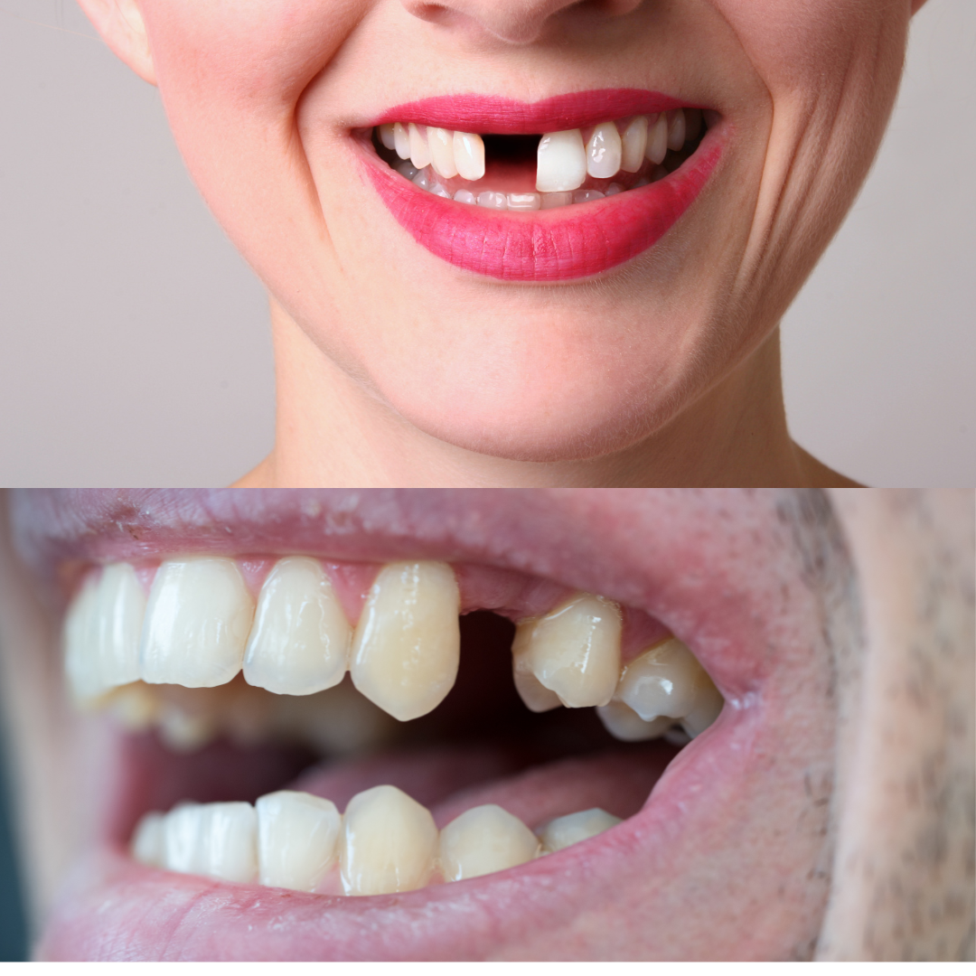 CPD Missing teeth