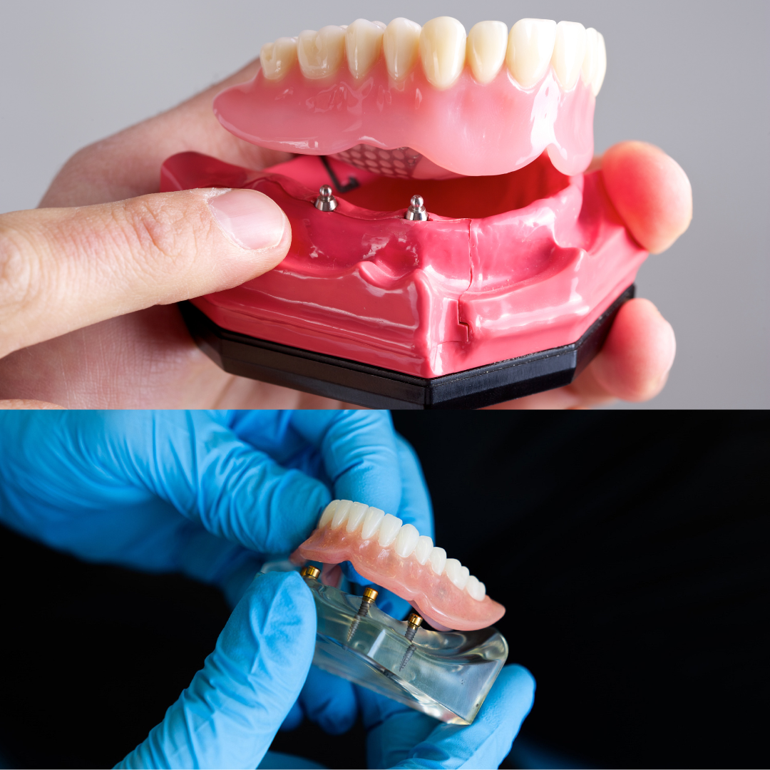 Overdentures