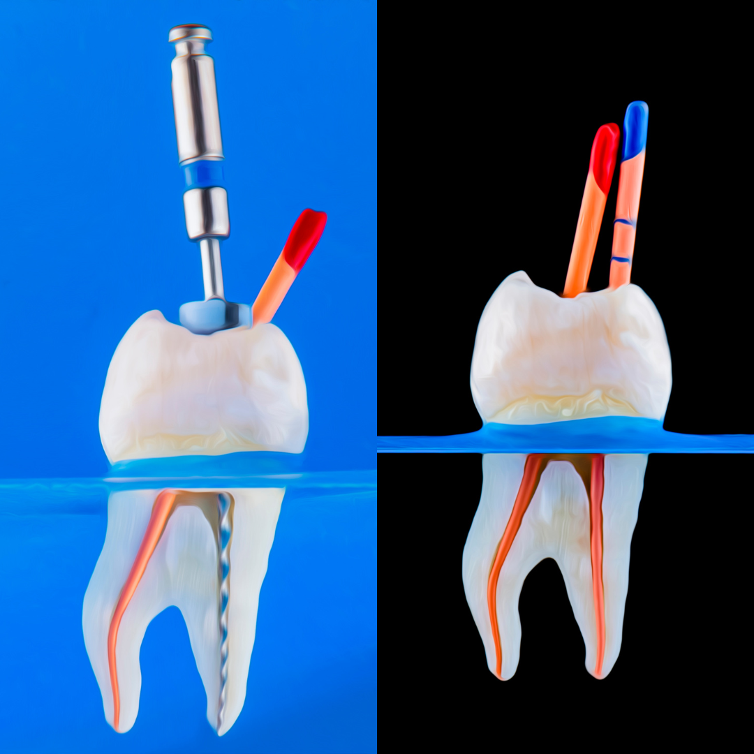 Root canal