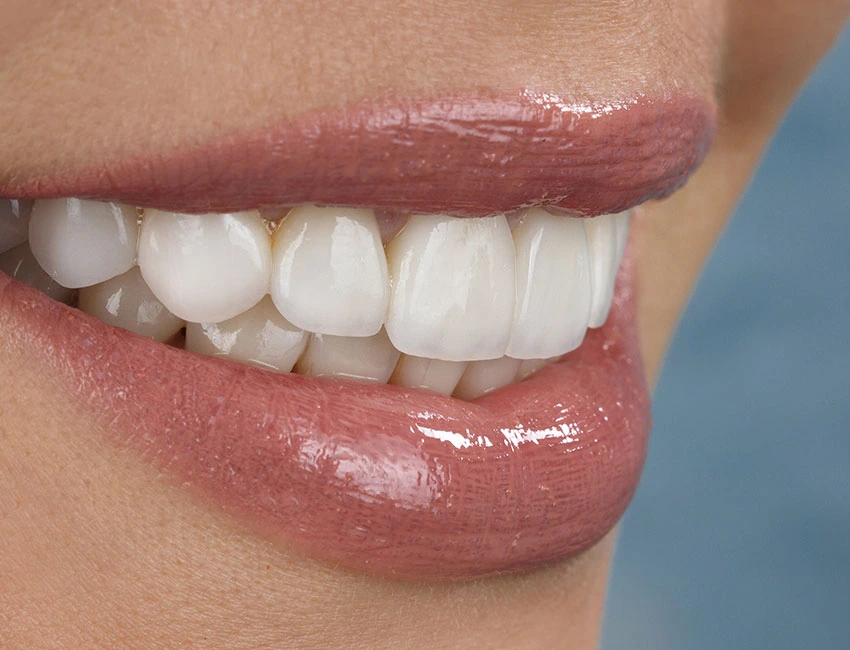 beautiful-smile-with-veneers
