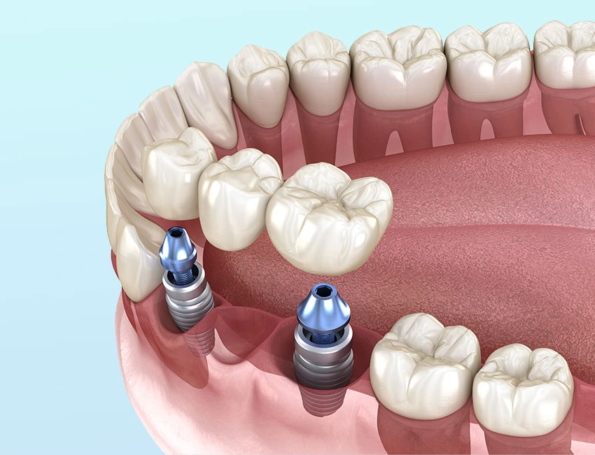 dental-bridge-implants