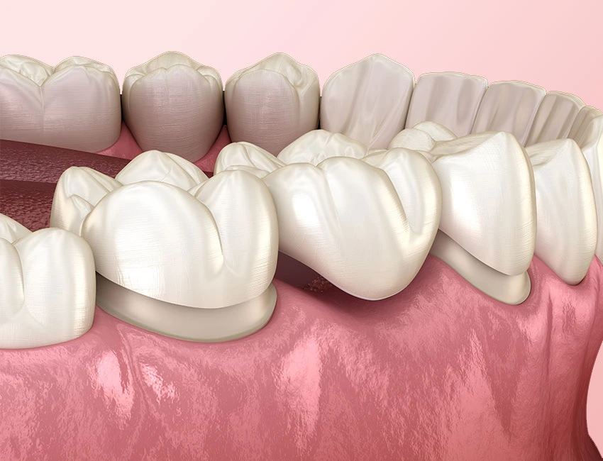 dental-bridge