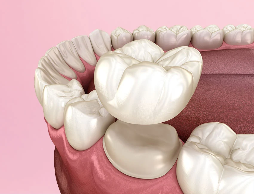 dental-crown-1