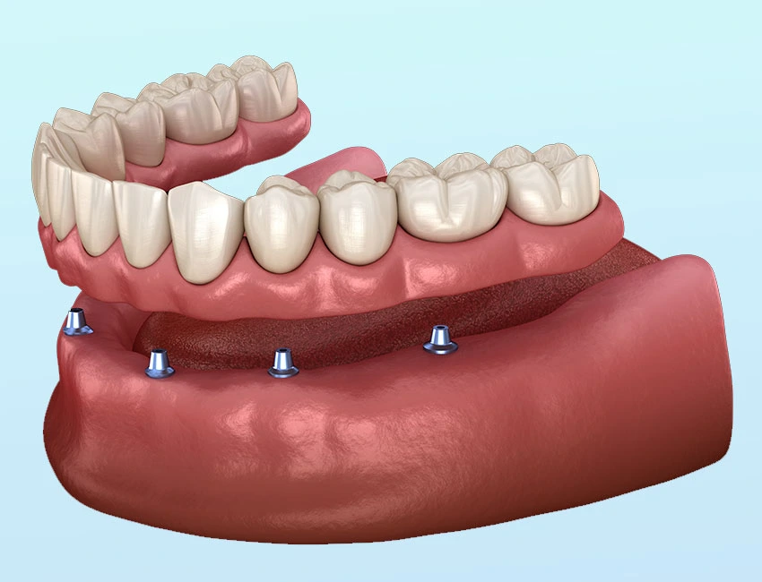 denture-supported-implants-snap-on