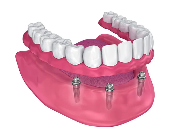implant-supported-dentures-overdentures