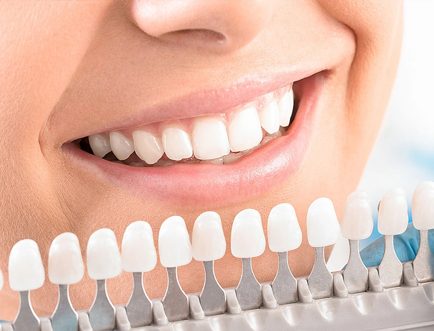 professional-teeth-Whitening