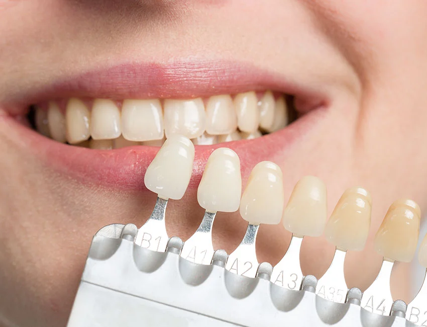 teeth-shade-guide